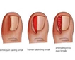 Ayak Tırnağı Batması Belirtileri ve Tedavisi