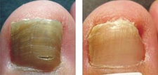 Ayak Tırnağı Mantarı Belirtileri ve Tedavisi