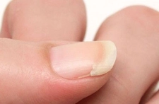 Kırık Tırnak Belirtileri ve Tedavisi