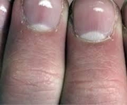 Tırnaklarda Beyazlık Belirtileri ve Tedavisi