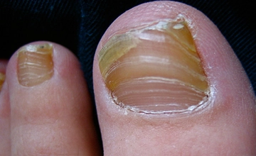 Ayak Tırnak Mantarı Belirtileri ve Tedavisi