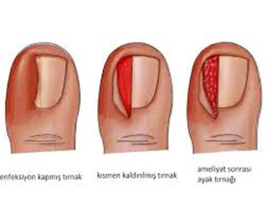 Ayak Trna Batmas