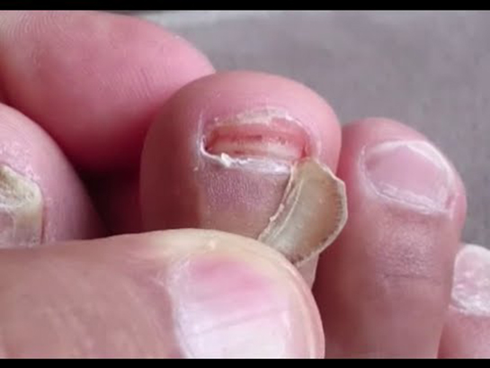 Ayak Tırnağı Çıkması Belirtileri ve Tedavisi