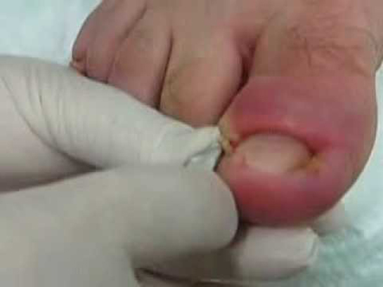 Ayak Tırnağı İltihabı Belirtileri ve Tedavisi