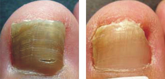 Ayak Tırnağı Mantarı Belirtileri ve Tedavisi