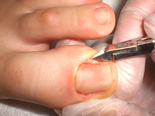 Batık Tırnak Belirtileri ve Tedavisi