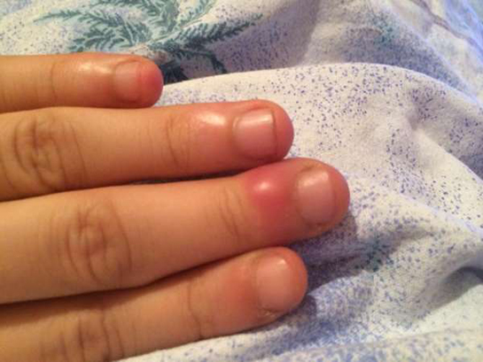 El Tırnak Batması Belirtileri ve Tedavisi