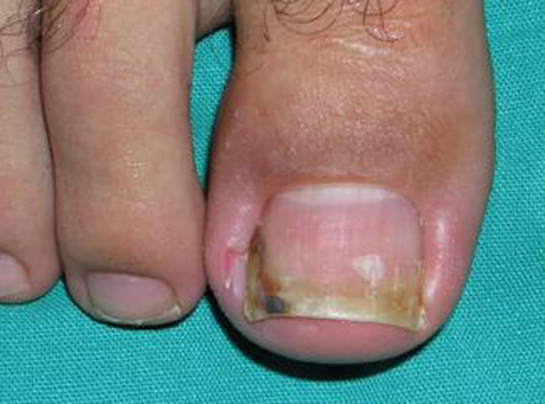 Tırnak Altı İltihabı Belirtileri ve Tedavisi