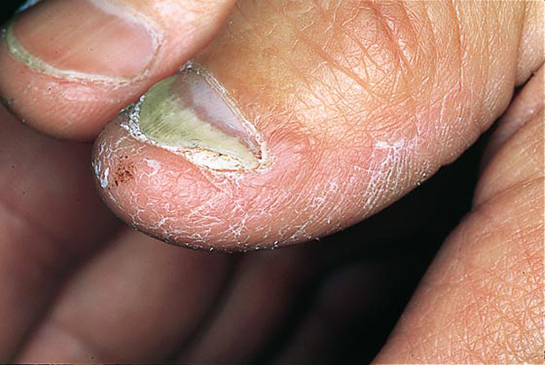 Tırnak Altı Mantarı Belirtileri ve Tedavisi