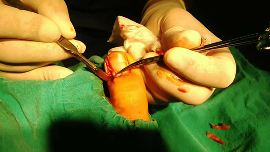 Tırnak Ameliyatı Riskleri ve Sonrası