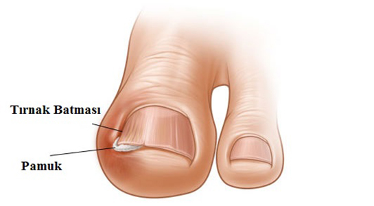 Tırnak Batması Belirtileri ve Tedavisi