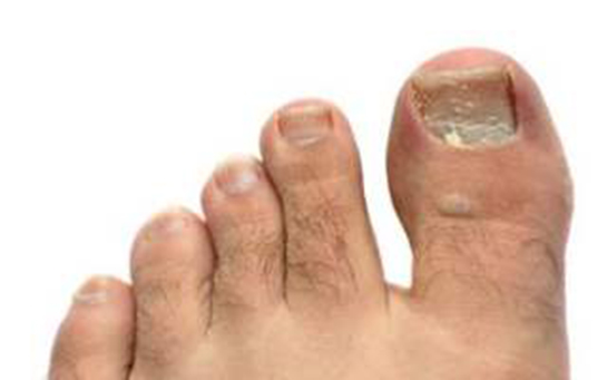 Tırnak Bozuklukları Belirtileri ve Tedavisi