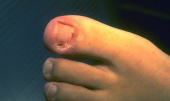 Tırnak Çekimi Belirtileri ve Tedavisi