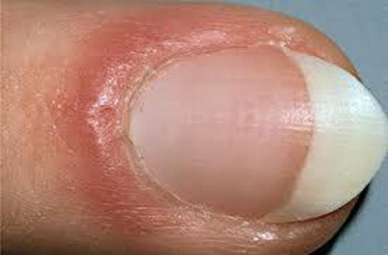 Tırnak Eti İltihabı Belirtileri ve Tedavisi