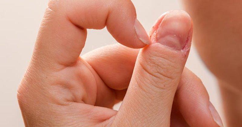 Tırnak Kanaması Belirtileri ve Tedavisi