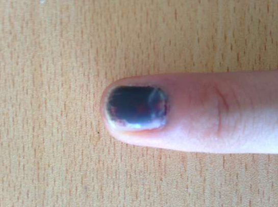 Tırnak Kararması Belirtileri ve Tedavisi