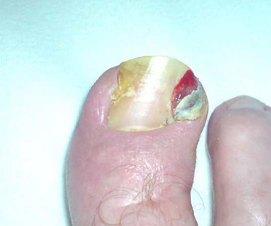 Tırnak Kopması Belirtileri ve Tedavisi