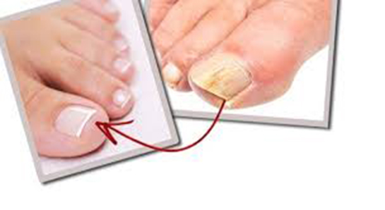 Tırnak Mantarı Bitkisel Tedavi