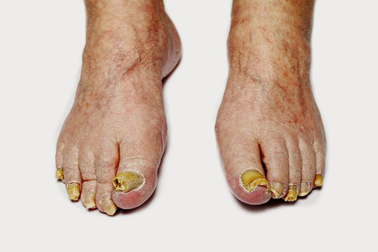 Tırnak Mantarı İlacı Kullanımı ve Faydaları Nelerdir?