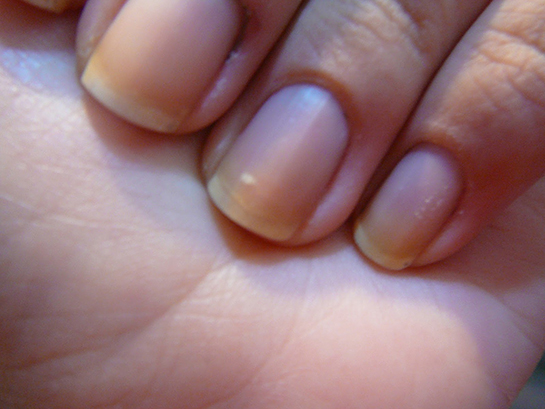 Tırnak Sararması Belirtileri ve Tedavisi