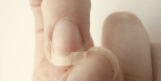 Tırnak Sedefi Belirtileri ve Tedavisi