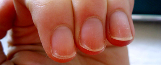 Tırnak Soyulması Belirtileri ve Tedavisi