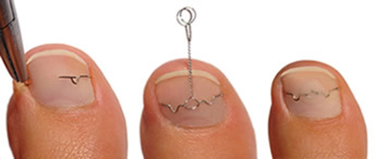 Tırnak Teli Kullanımı ve Faydaları Nelerdir?