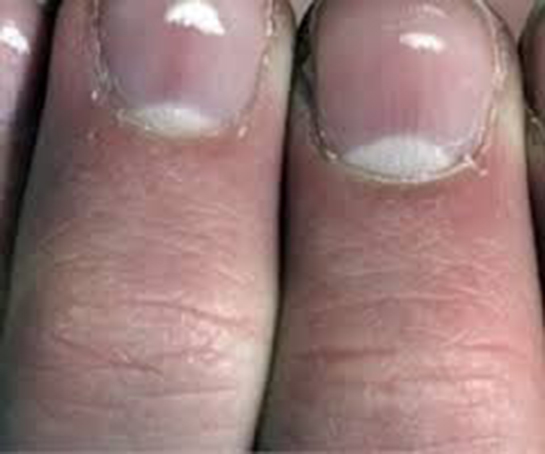 Tırnaklarda Beyazlık Belirtileri ve Tedavisi