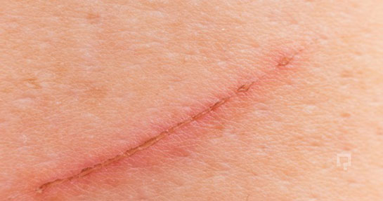 Yüzdeki Tırnak İzi Nasıl Geçer?